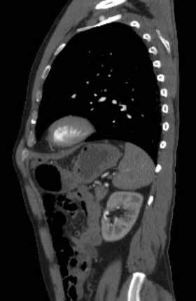 File:Aortic dissection - Stanford type B (Radiopaedia 73648-84437 C 41).jpg