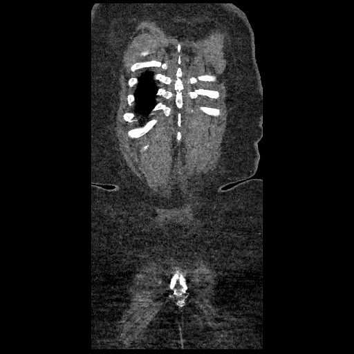 File:Aortic dissection - Stanford type B (Radiopaedia 88281-104910 B 87).jpg