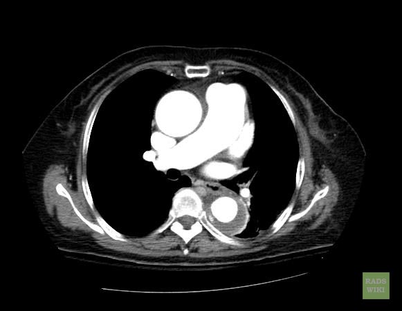 File:Aortic intramural hematoma (Radiopaedia 11198-11562 D 1).jpg