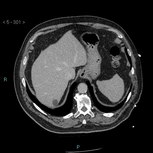 Aortic intramural hematoma (Radiopaedia 48463-53380 C 135).jpg