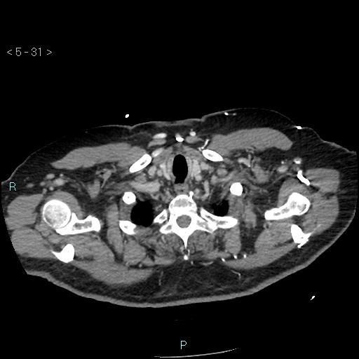 File:Aortic intramural hematoma (Radiopaedia 48463-53380 C 15).jpg