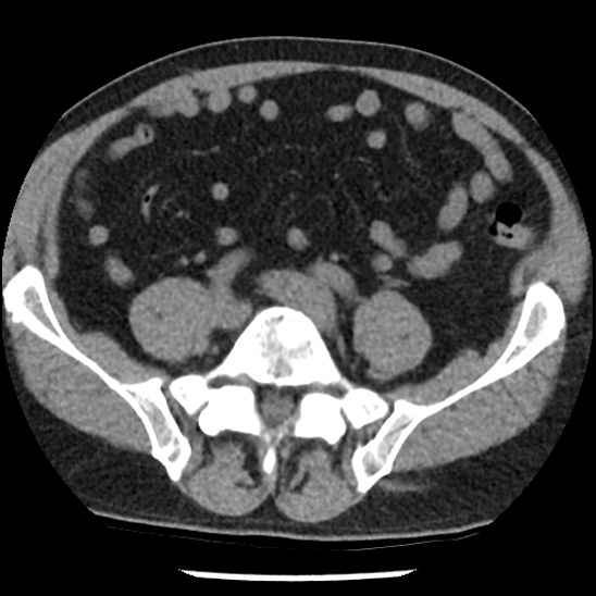 Aortic intramural hematoma (type B) (Radiopaedia 79323-92387 Axial non-contrast 88).jpg