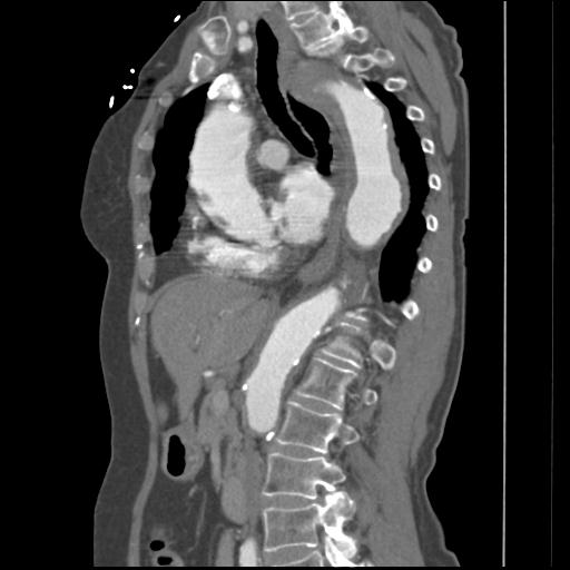 File:Aortic intramural hematoma from penetrating atherosclerotic ulcer (Radiopaedia 31137-31836 B 20).jpg