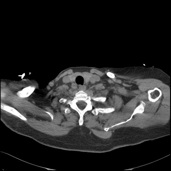 File:Aortic intramural hematoma with dissection and intramural blood pool (Radiopaedia 77373-89491 Axial non-contrast 11).jpg
