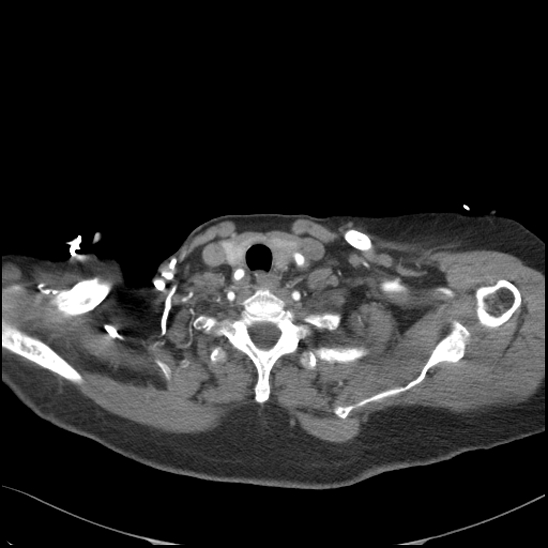 Aortic intramural hematoma with dissection and intramural blood pool (Radiopaedia 77373-89491 B 23).jpg