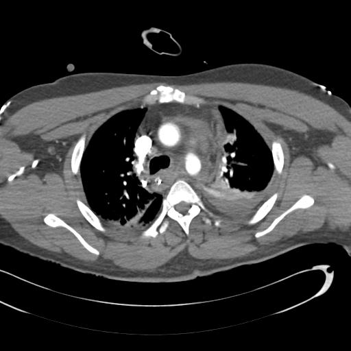 Aortic transection, diaphragmatic rupture and hemoperitoneum in a complex multitrauma patient (Radiopaedia 31701-32622 A 31).jpg