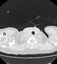 File:Aortic valve endocarditis (Radiopaedia 87209-103485 Axial lung window 6).jpg