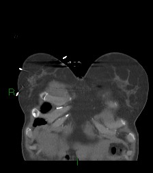 Aortic valve endocarditis (Radiopaedia 87209-103485 D 66).jpg