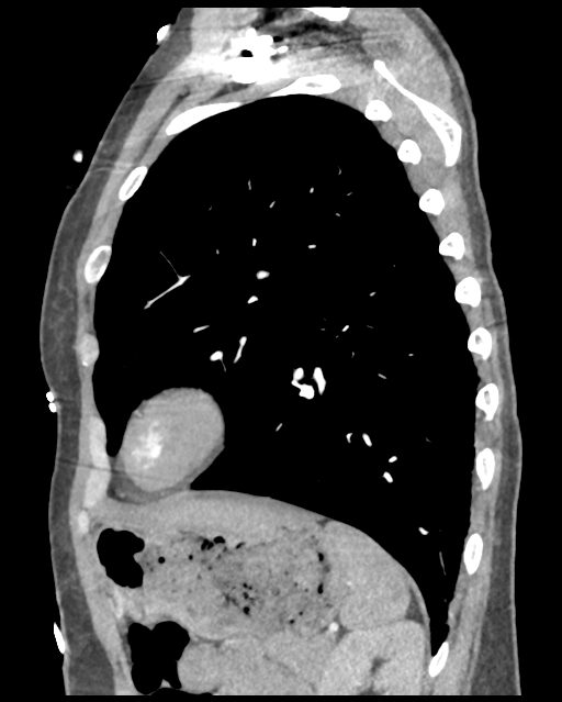 Aortic valve non-coronary cusp thrombus (Radiopaedia 55661-62189 D 15).png