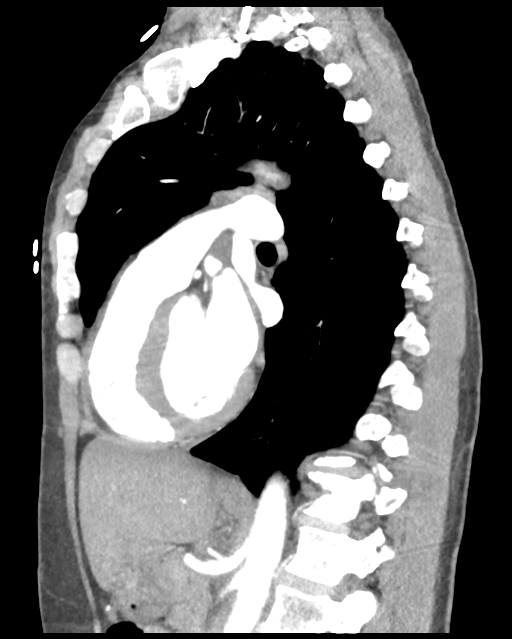 Aortic valve non-coronary cusp thrombus (Radiopaedia 55661-62189 D 24).png