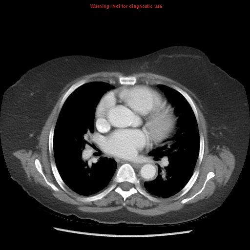 File:Aortic valve stenosis (Radiopaedia 14480-14423 C 2).jpg
