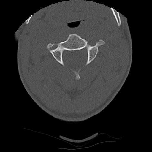File:Apical pneumothorax on cervical spine CT (Radiopaedia 45343-49368 Axial bone window 24).jpg