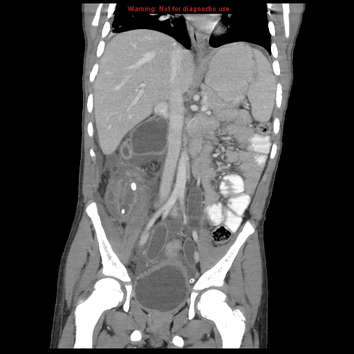 File:Appendicitis with phlegmon (Radiopaedia 9358-10046 B 37).jpg