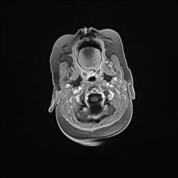 Aqueductal stenosis (Radiopaedia 73974-84802 Axial T1 C+ 34).jpg