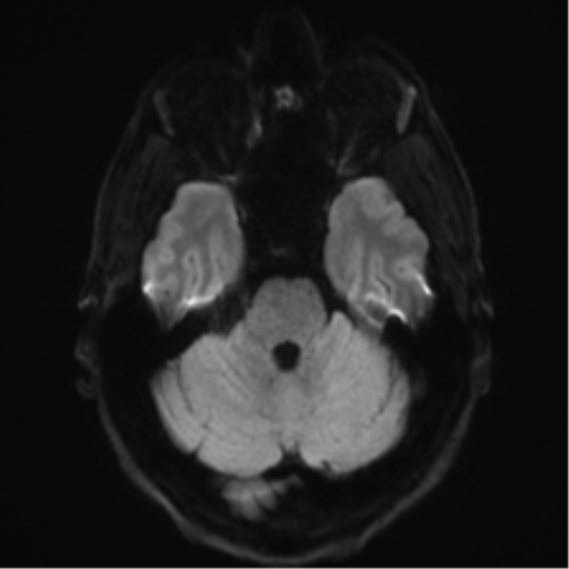 Arachnoid cyst - cerebellopontine angle (Radiopaedia 59689-67083 Axial DWI 47).png