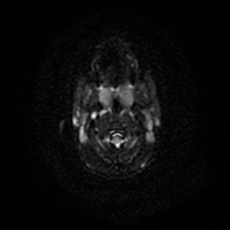 Arachnoid cyst - middle cranial fossa (Radiopaedia 86780-102938 Axial DWI 58).jpg