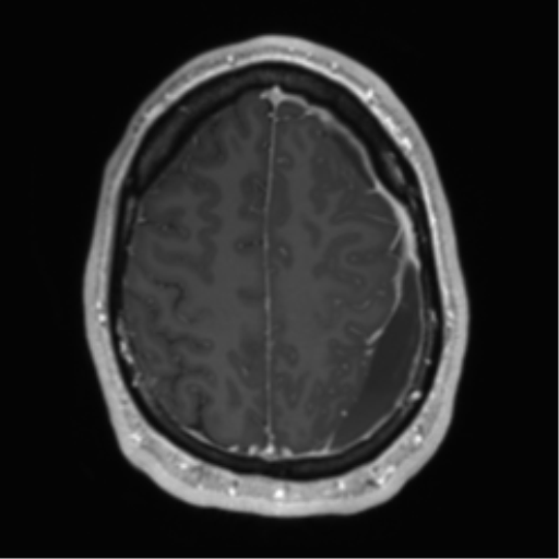 File:Arachnoid cyst with subdural hematoma (Radiopaedia 85892-101743 Axial T1 C+ 66).png