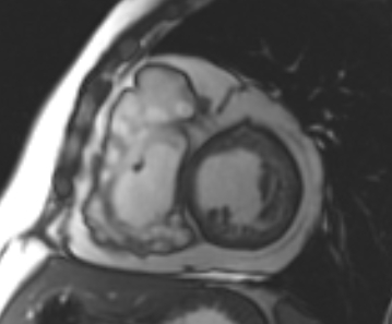 File:Arrhythmogenic right ventricular cardiomyopathy (Radiopaedia 69431-79307 Short axis cine 124).jpg