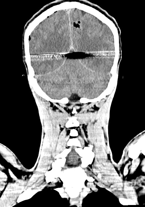 Arrow injury to the brain (Radiopaedia 72101-82607 Coronal non-contrast 55).jpg