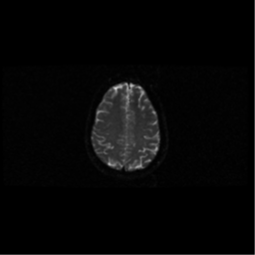 File:Arteriovenous malformation (cerebral) (Radiopaedia 40070-42580 Axial DWI 39).png