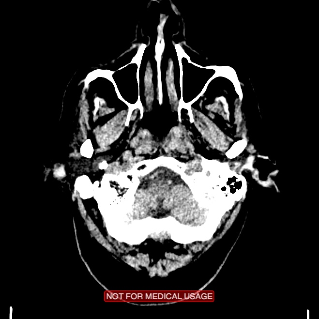 Artery of Percheron infarction (Radiopaedia 28679-28967 Axial non-contrast 11).jpg