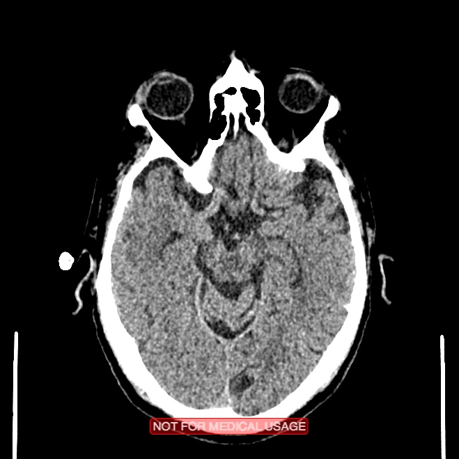 Artery of Percheron infarction (Radiopaedia 28679-28967 Axial non-contrast 47).jpg