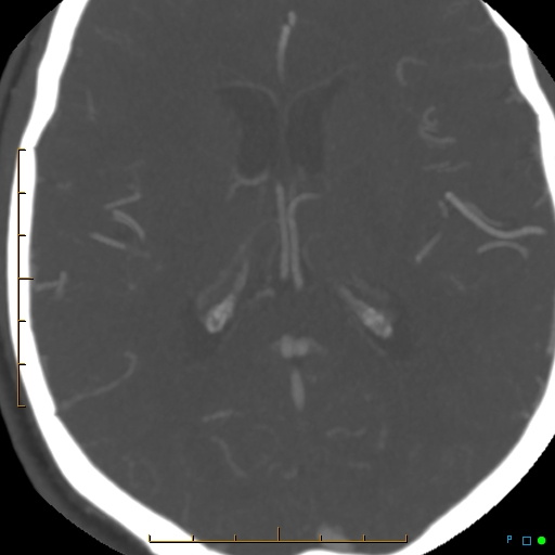 File:Artifactual basilar artery stenosis due to metallic stent (Radiopaedia 31206-31923 A 26).jpg