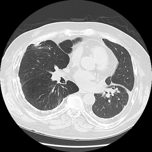 Asbestos-related pleural disease (Radiopaedia 74366-85250 Axial lung window 65).jpg