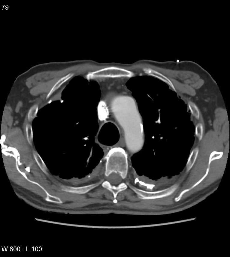 Asbestos related lung and pleural disease (Radiopaedia 14377-14301 D 15).jpg