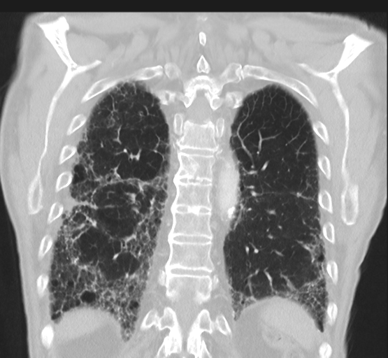Asbestosis (Radiopaedia 56192-62864 Coronal lung window 41).png