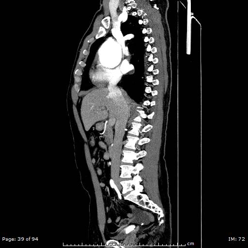 File:Ascending aortic aneurysm (Radiopaedia 50086-55404 C 28).jpg
