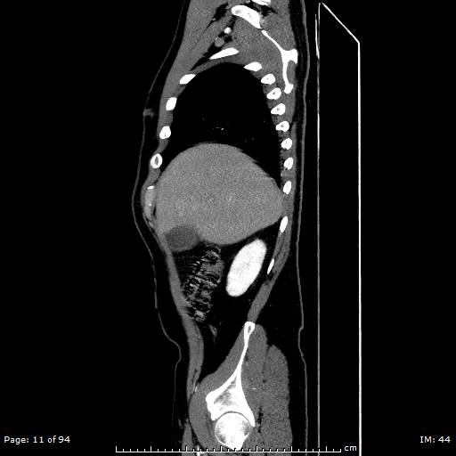 File:Ascending aortic aneurysm (Radiopaedia 50086-55404 C 8).jpg