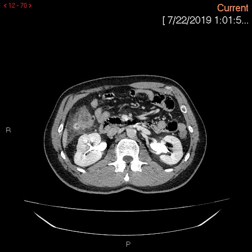 File:Ascending colonic diverticulum mimicking acute appendicitis (Radiopaedia 69943-80198 A 70).jpg