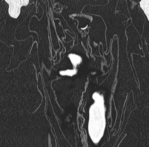 Aspergilloma- with Monod sign (Radiopaedia 44737-48532 Coronal lung window 100).jpg
