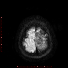 Astroblastoma (Radiopaedia 74287-85162 Axial DWI 102).jpg