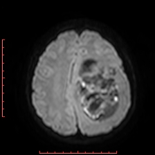 Astroblastoma (Radiopaedia 74287-85162 Axial DWI 75).jpg
