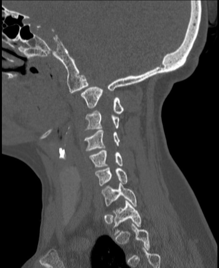 Atlanto-occipital assimilation with basilar invagination (Radiopaedia 70122-80188 Sagittal bone window 27).jpg