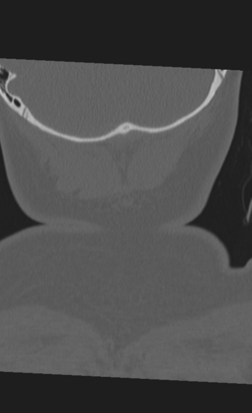Atlanto-occipital dissociation (Radiopaedia 33848-35013 Coronal bone window 59).png