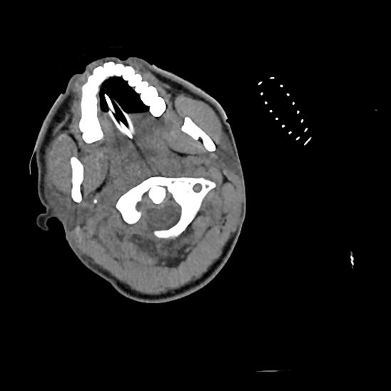 File:Atlanto-occipital dissociation (Traynelis type 1), C2 teardrop fracture, C6-7 facet joint dislocation (Radiopaedia 87655-104061 Axial non-contrast 13).jpg