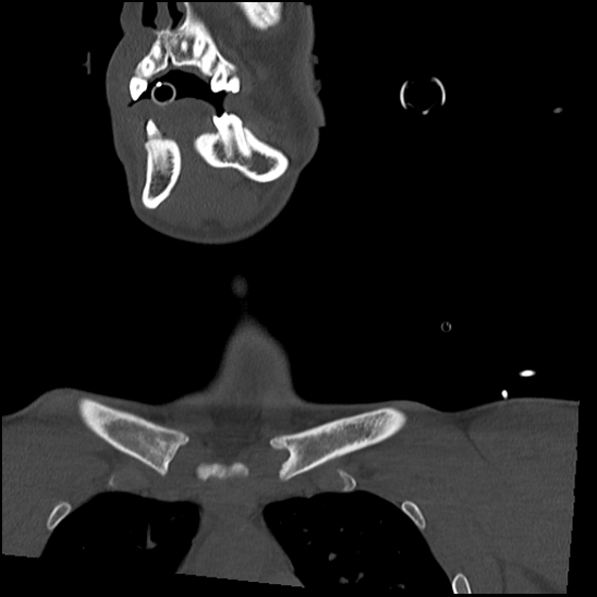 Atlanto-occipital dissociation (Traynelis type 1), C2 teardrop fracture, C6-7 facet joint dislocation (Radiopaedia 87655-104061 Coronal bone window 9).jpg