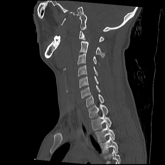 Atlanto-occipital dissociation (Traynelis type 1), C2 teardrop fracture, C6-7 facet joint dislocation (Radiopaedia 87655-104061 Sagittal bone window 41).jpg
