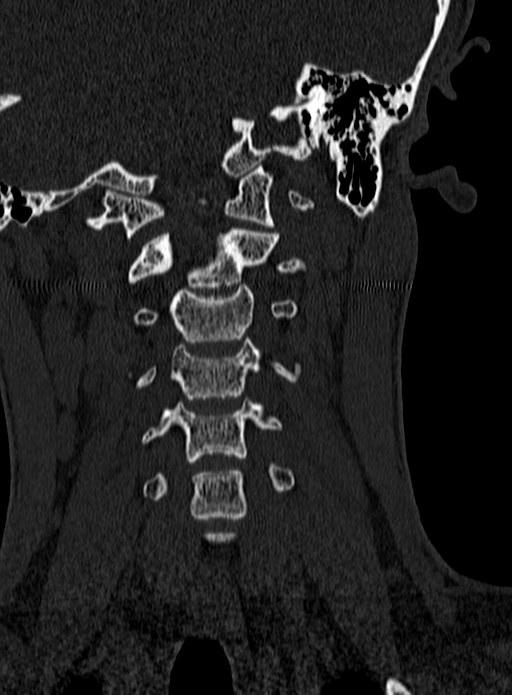 Atlantoaxial subluxation (Radiopaedia 44681-48450 Coronal bone window 45).jpg
