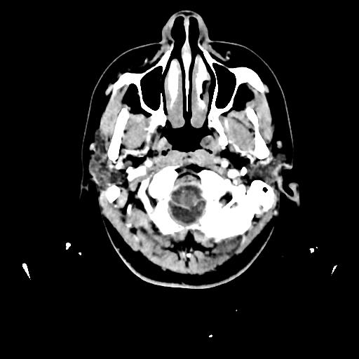 Atretic cephalocele (Radiopaedia 89782-106881 Axial with contrast 15).jpg