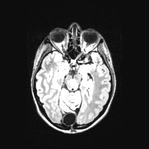 Atretic encephalocoele with inferior vermis hypoplasia (Radiopaedia 30443-31108 Axial 63).jpg