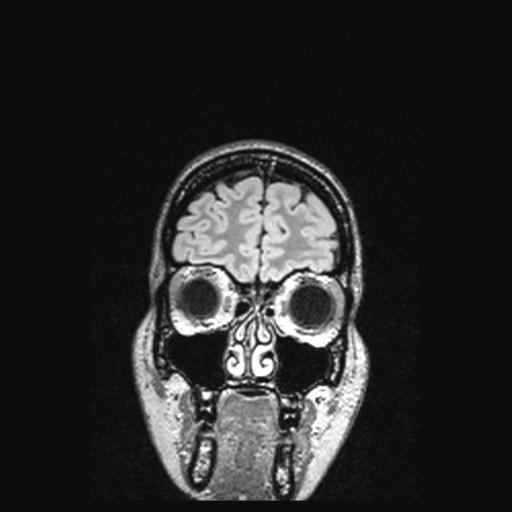 File:Atretic encephalocoele with inferior vermis hypoplasia (Radiopaedia 30443-31108 Coronal FLAIR 156).jpg