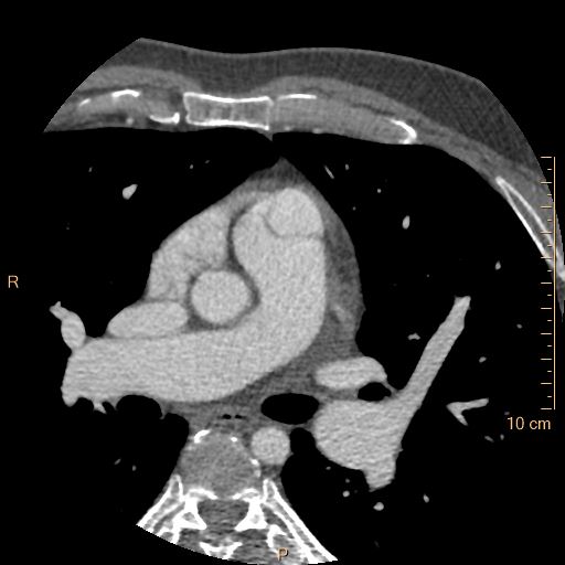 Atrial septal defect (upper sinus venosus type) with partial anomalous pulmonary venous return into superior vena cava (Radiopaedia 73228-83961 A 79).jpg