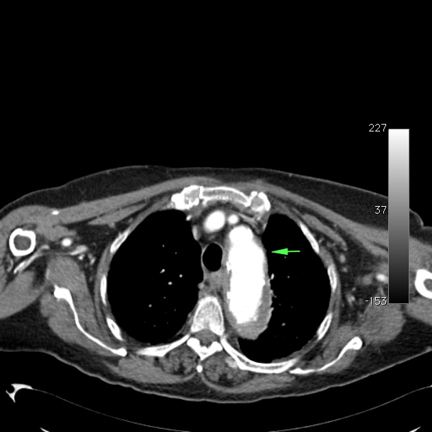 Atypical dissection of the thoracic aorta (Radiopaedia 10975-11393 A 13).jpg