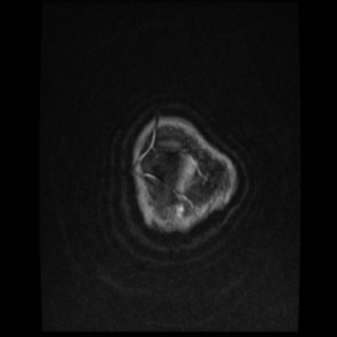 Atypical meningioma (Radiopaedia 45535-49629 Axial T1 C+ 64).jpg