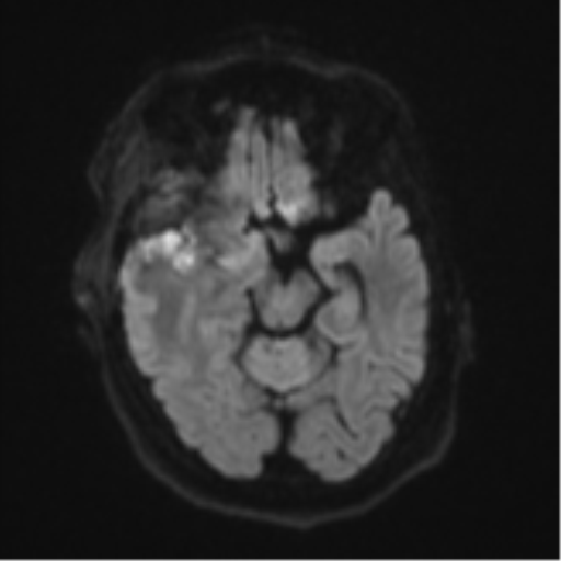 Atypical meningioma (WHO Grade II) (Radiopaedia 54742-60981 Axial DWI 39).png
