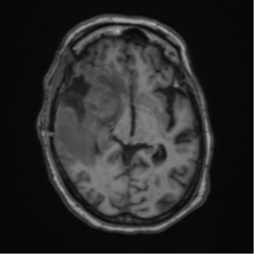 Atypical meningioma (WHO Grade II) (Radiopaedia 54742-60981 Axial T1 32).png